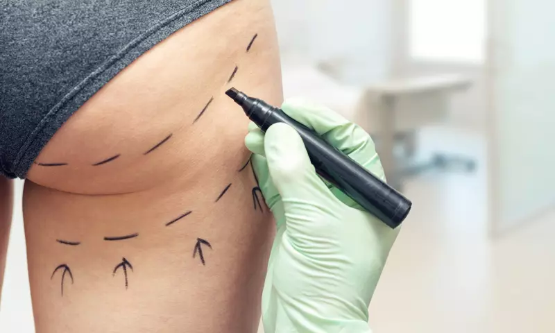 Liposuktion bei einem Lipödem