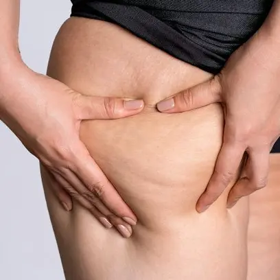 Liposuktion bei einem Lipödem