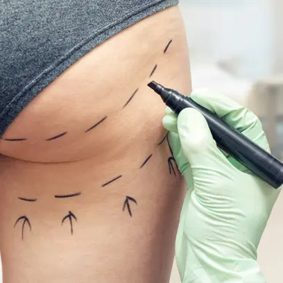 Mein Gewicht nach einer Liposuktion.